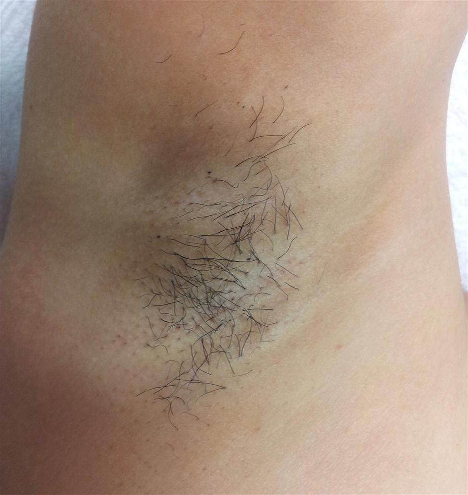 Hair Removal After Treatment